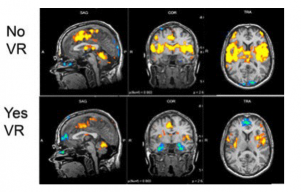 области в мозге слабее возбуждаются от боли, если пациент погружён в виртуальную реальность